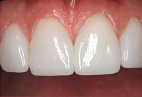 The image shows a close-up of a person s teeth with stains on them, emphasizing the need for dental care and cleaning.