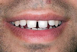 The image shows a close-up of a person s face with an open mouth displaying teeth, revealing a smile with a missing tooth on the lower right side.