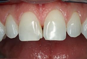 The image shows a close-up view of a person s teeth with some visible decay and staining, particularly on the front teeth, which are prominently white with darker areas indicating cavities or discoloration.